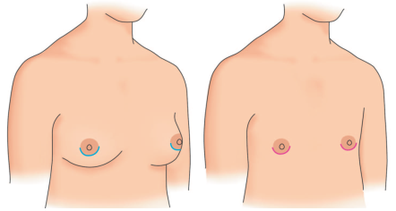 乳房たるみ時の手術